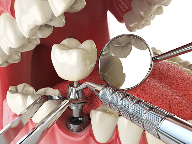 Best Emergency Tooth Extraction in Midland, WA
