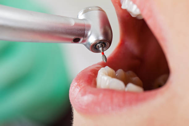 Best Emergency Wisdom Teeth Removal in Midland, WA
